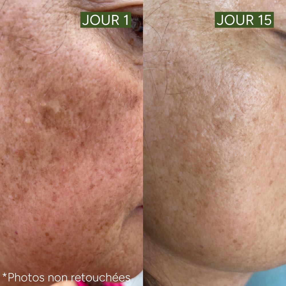 The unifying anti-blemish serum