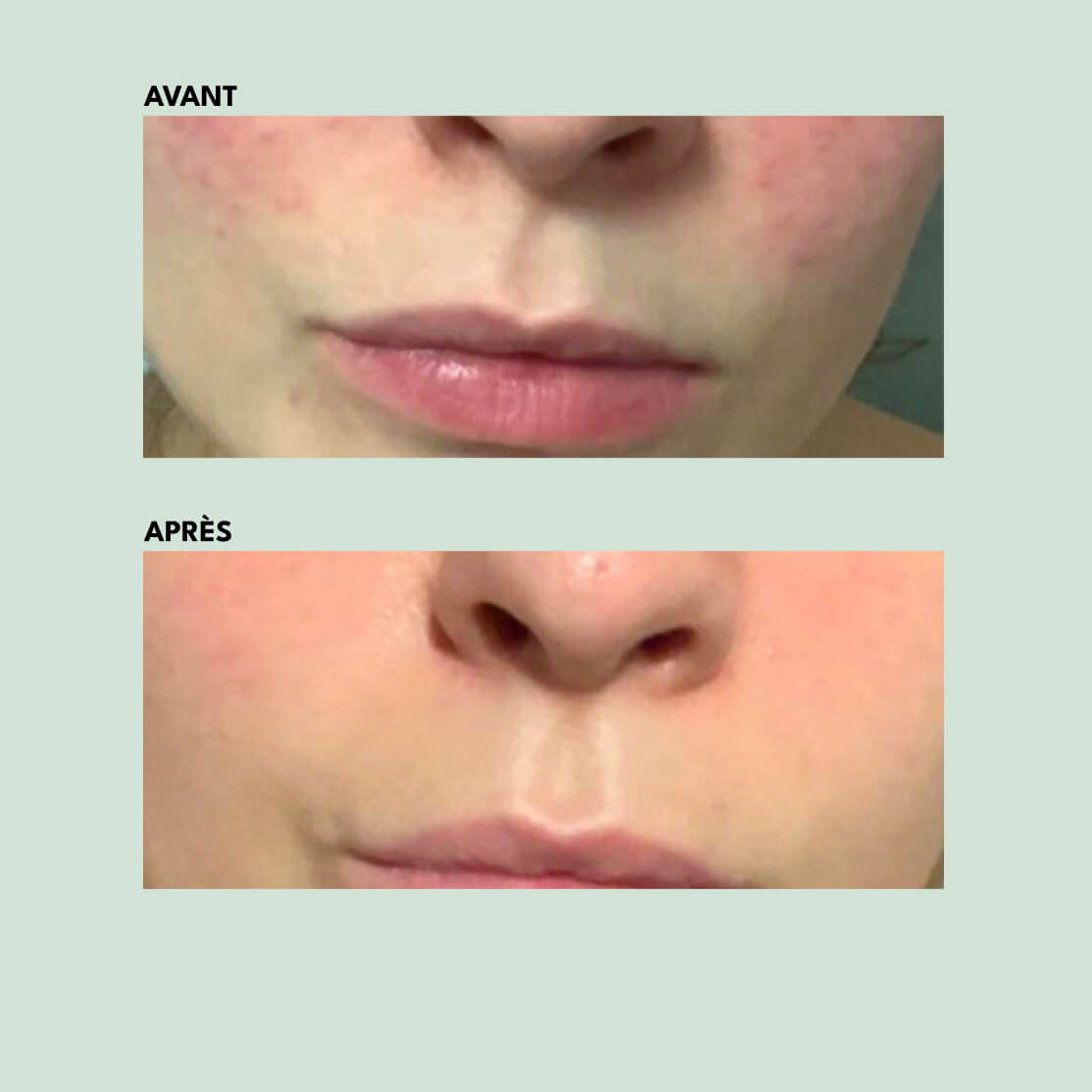 Light Cream - Anti-Blemish | 30ml