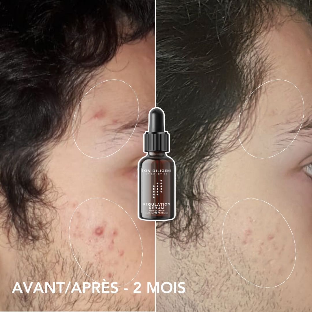 ACNE KIT