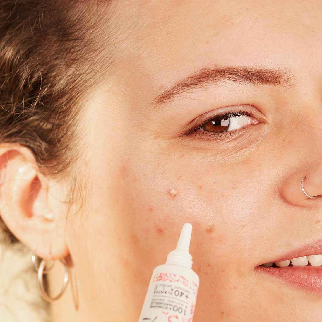 Targeted SOS acne treatment